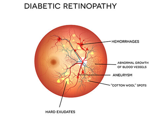 Diabetic-Retinopathy-new