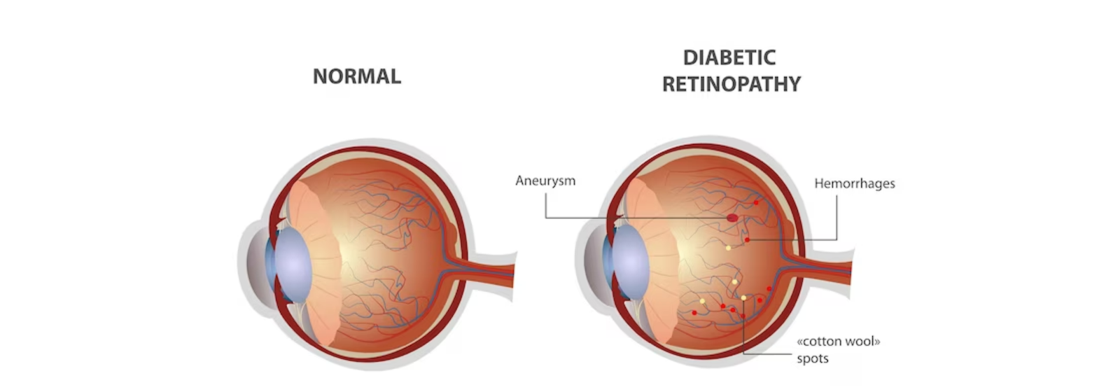 Diabetic Retinopathy