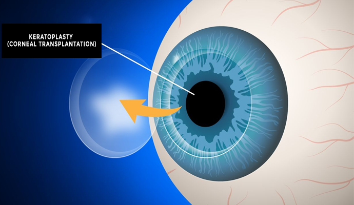 Keratoplasty-(Corneal-Transplantation)