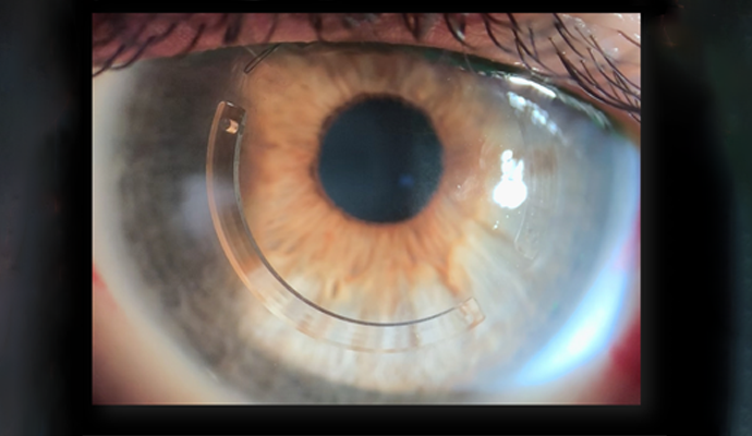 one aIntracorneal-Ring-Segments-(INTACS)